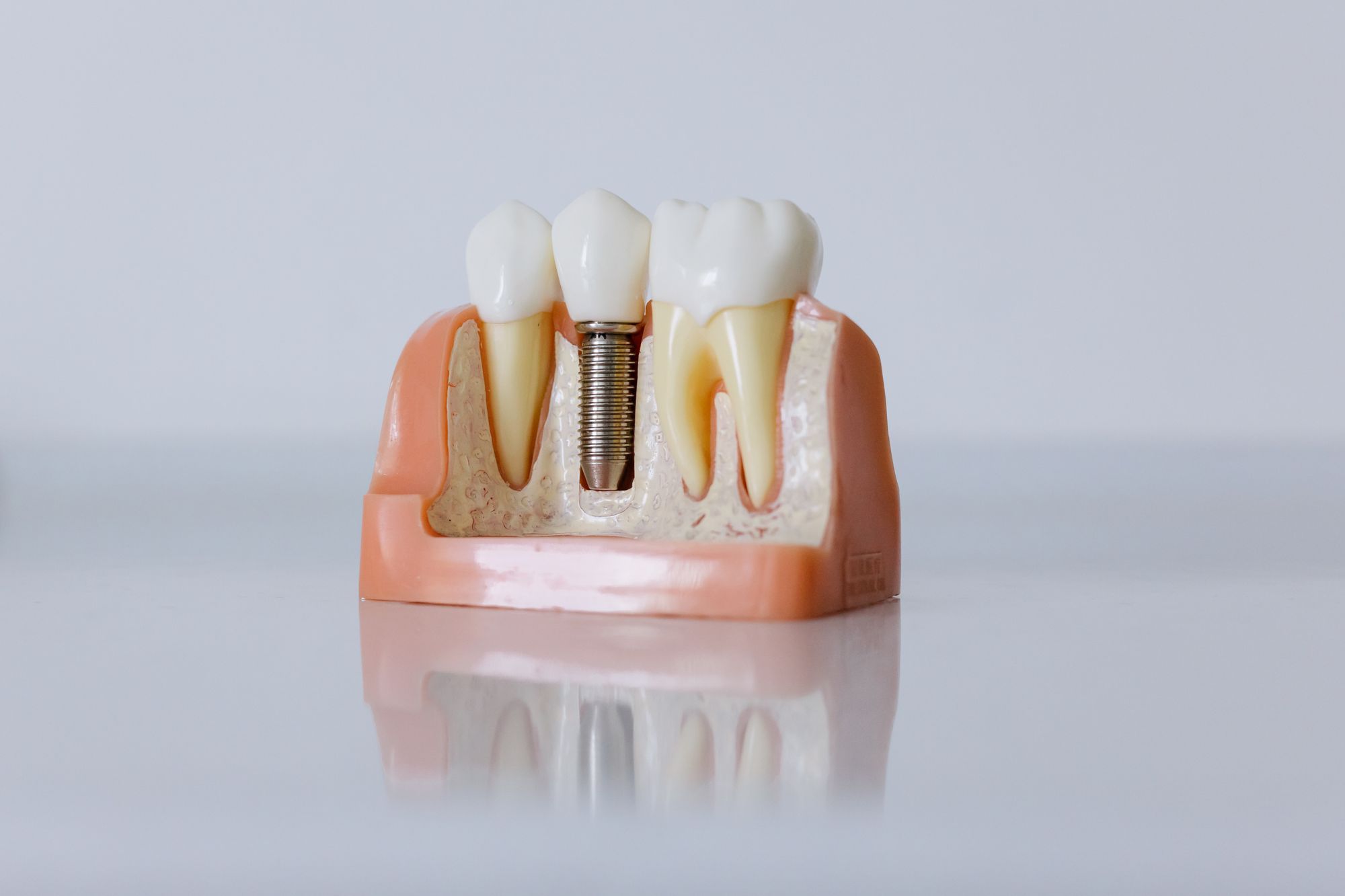 Implantes dentales